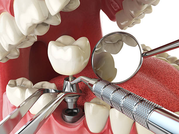 Best Emergency Wisdom Teeth Removal in Mount Dora, FL